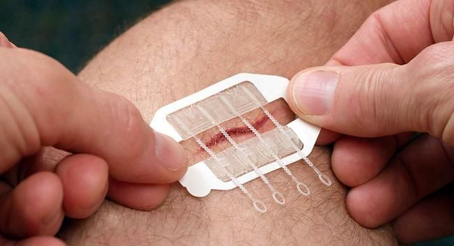 ZipStitch Wundverschlusssystem für Schnitte bis 3 cm