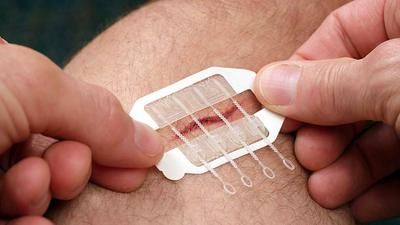 ZipStitch Wundverschlusssystem für Schnitte bis 3 cm